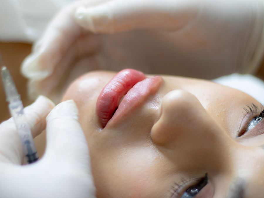 Lip filler treatment