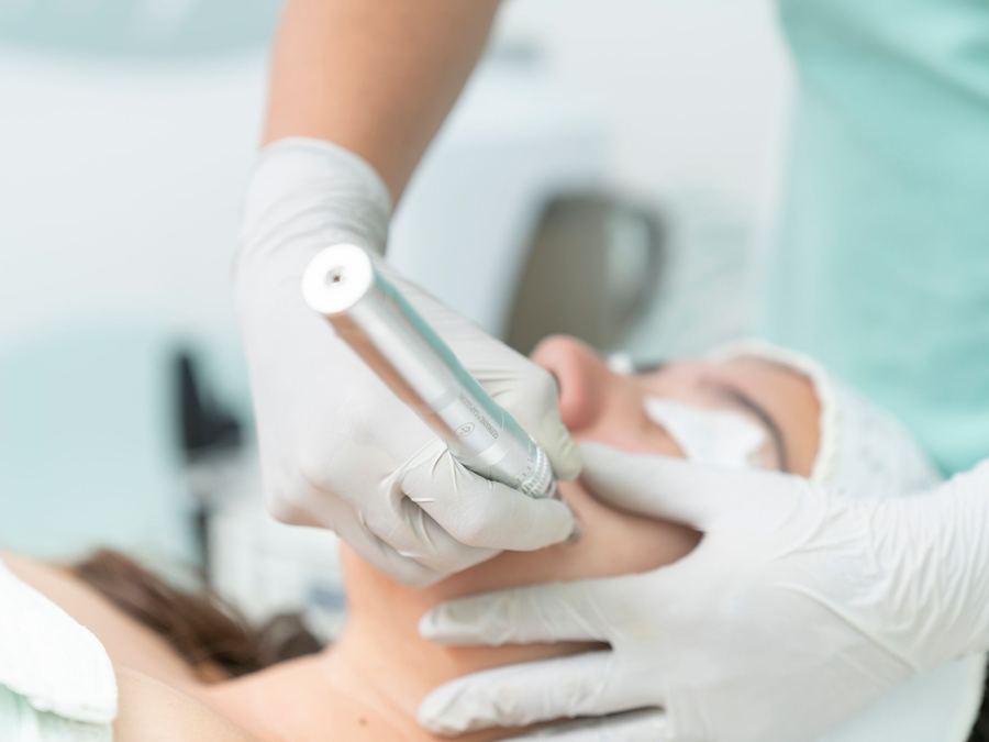 Microneedling treatment